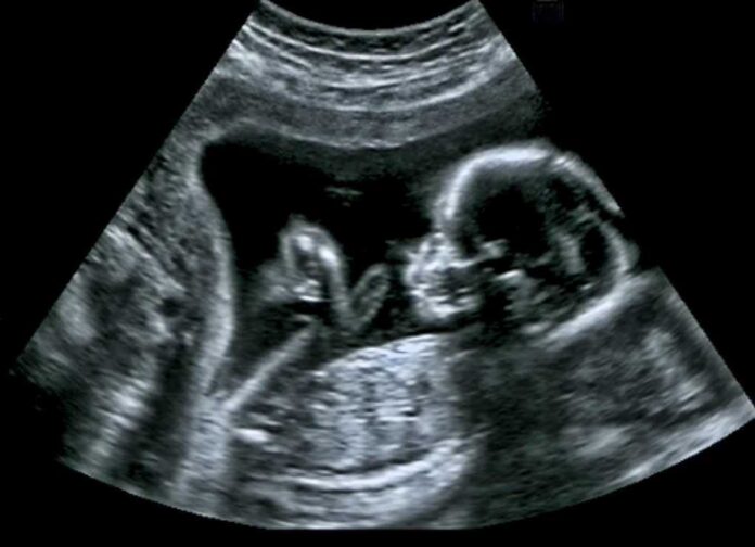 546641992 featured image Ultrasound image of fetus in womb
